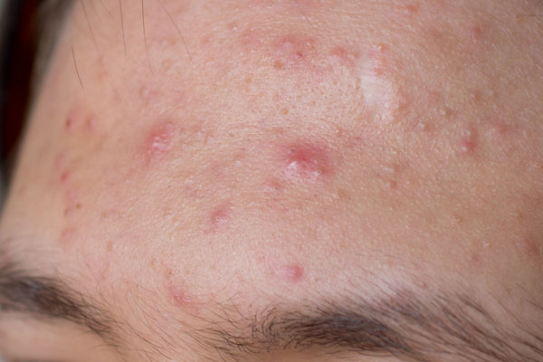 Fungal Acne: Dermatologist Tips and At-Home Treatments