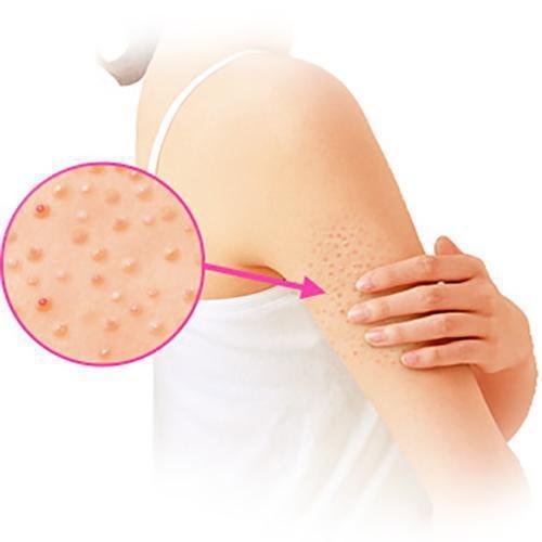 Kobayashi Nino Cure Medicated Cream for Keratosis Pilaris 30g